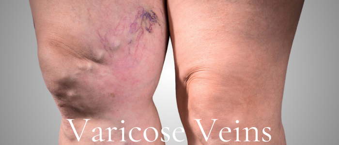 Varicose Veins WP